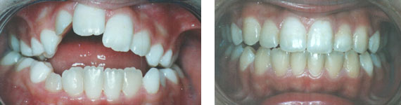 Before and After Braces